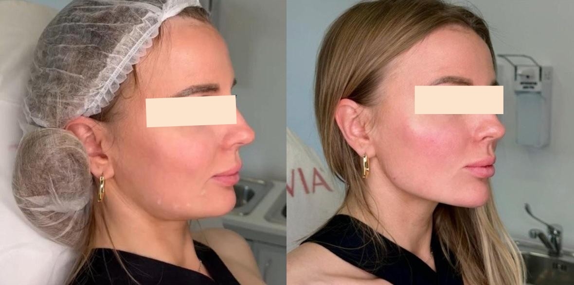 לפני ואחרי - עיצוב שפתיים