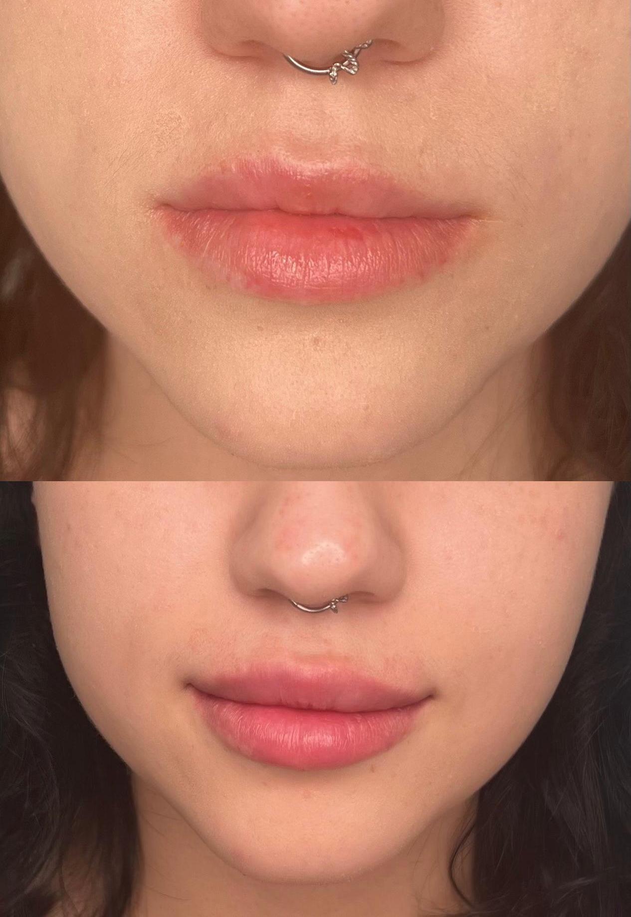 לפני ואחרי - פרופיל אף