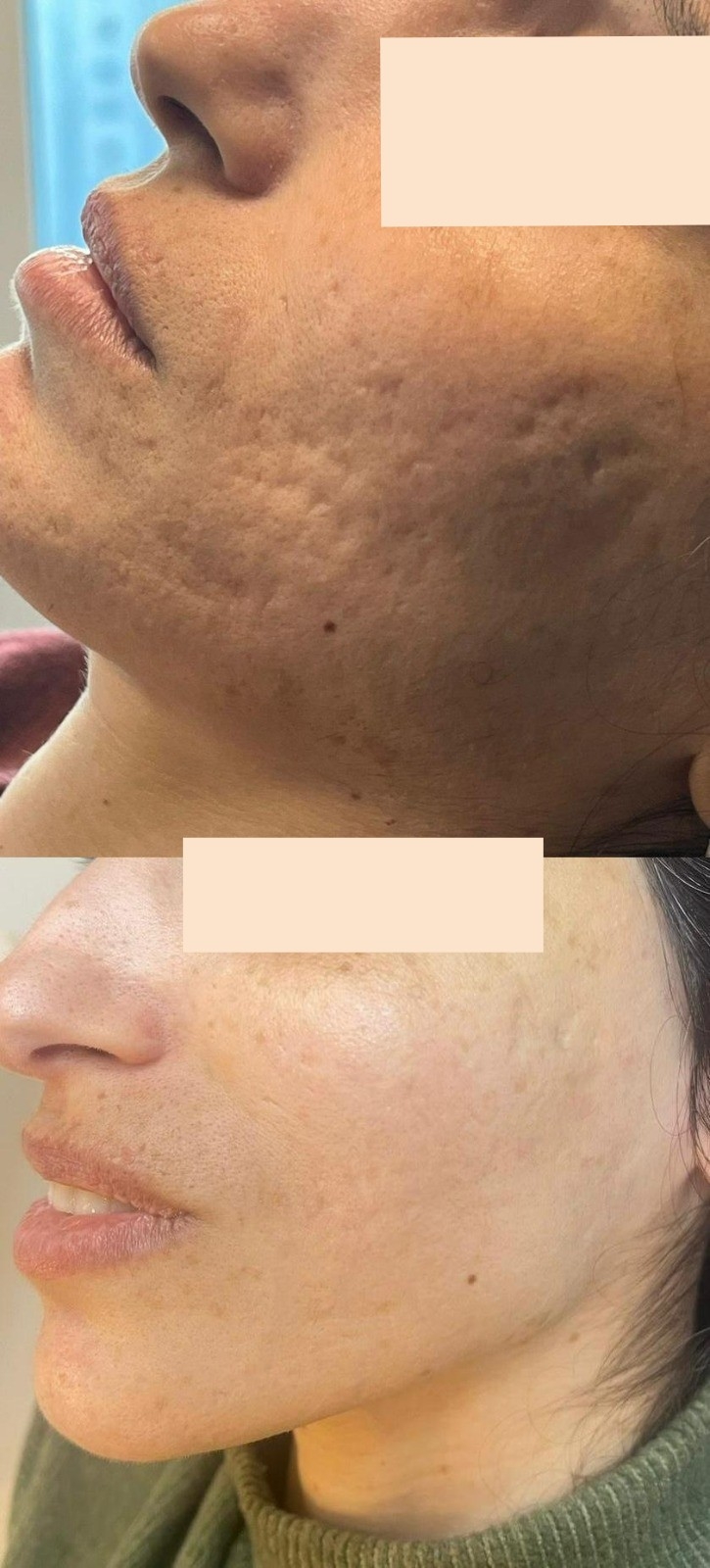 לפני ואחרי - שפתיים